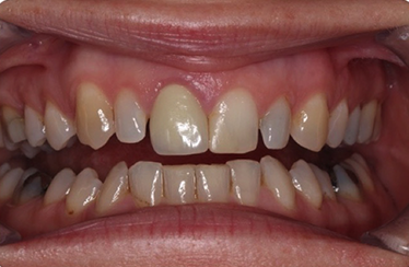 Before - Linden Dental Surgery