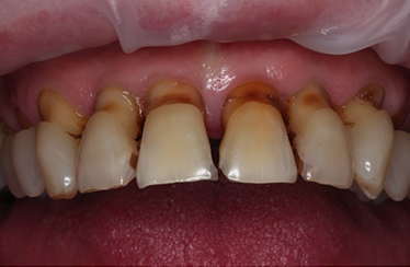 Before - Linden Dental Surgery