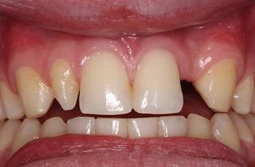 Before - Linden Dental Surgery