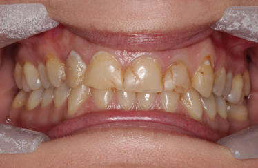 Before - Linden Dental Surgery